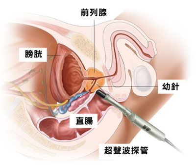 前列腺癌會引起男性乳